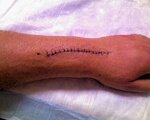 stitches (2).jpg