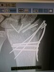 wrist x-ray.jpg